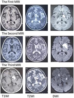 Progressive Stroke Caused by Neurosyphilis With Concentric Enhancement in the Internal Cerebral Artery on High-Resolution Magnetic Resonance Imaging: A Case Report